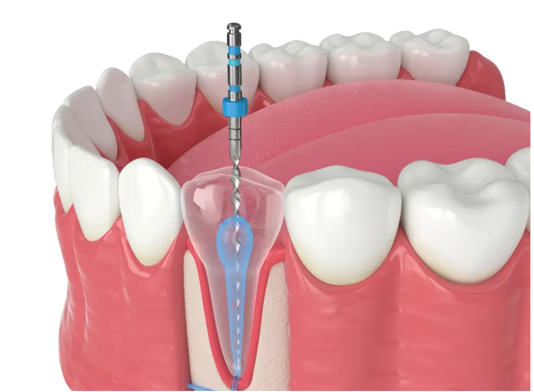 Root Canal Treatment