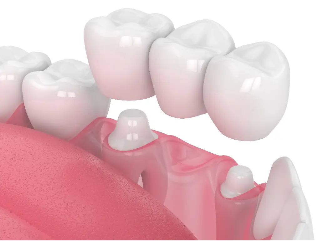 Dental Crowns & Bridges