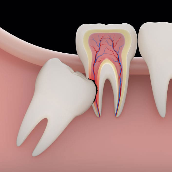 Wisdom Teeth Extractions